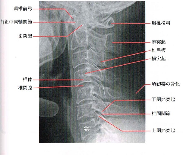 頚椎の棘突起骨折 症状 後遺障害等級 慰謝料について解説 後遺障害無料相談 秋葉行政書士事務所