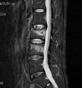 20110805MRI STIR確認 web
