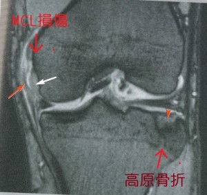 MCL損傷20141203_0000